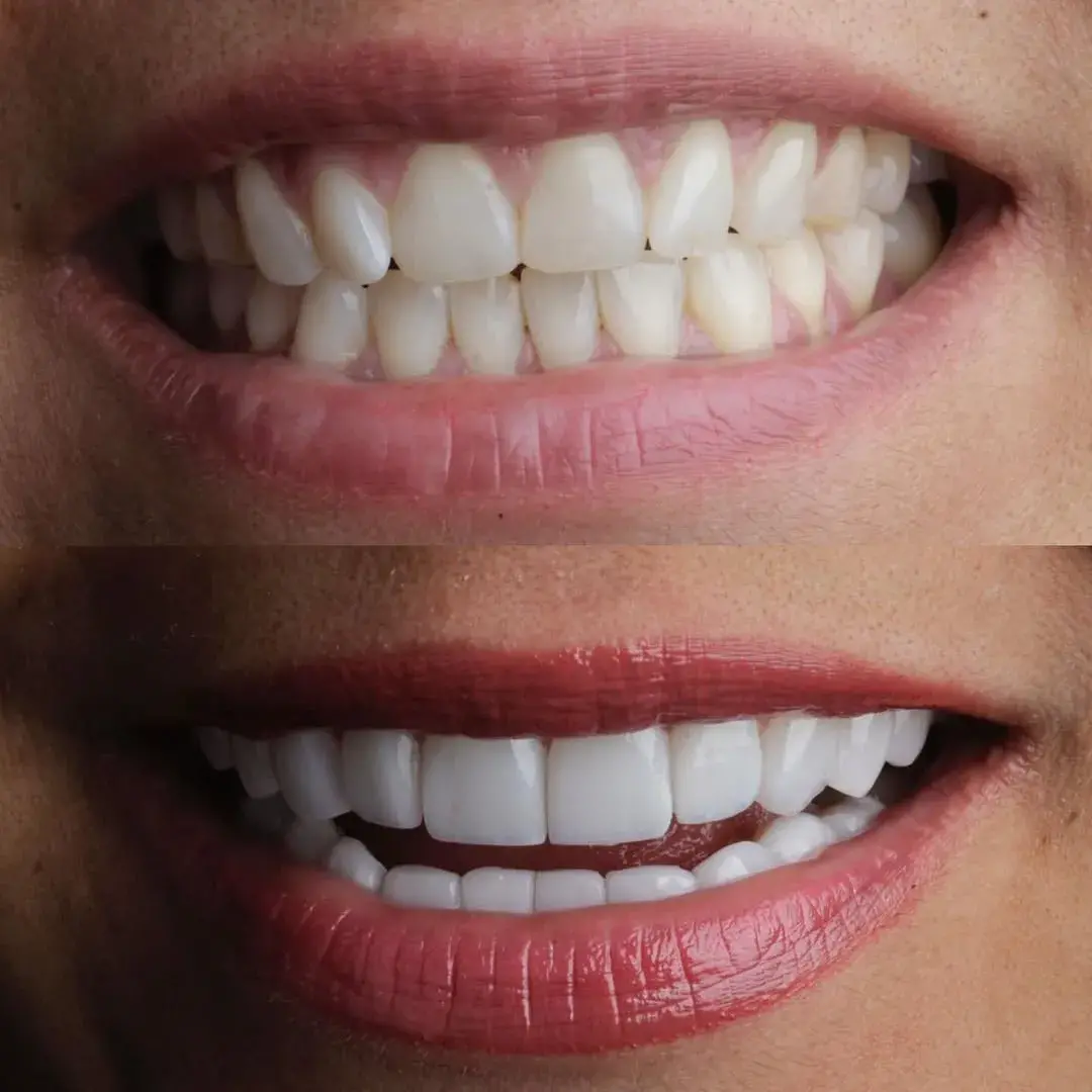 Carillas de porcelana diseñadas a la perfección para ti #emaxveneers #smiledesign #cali