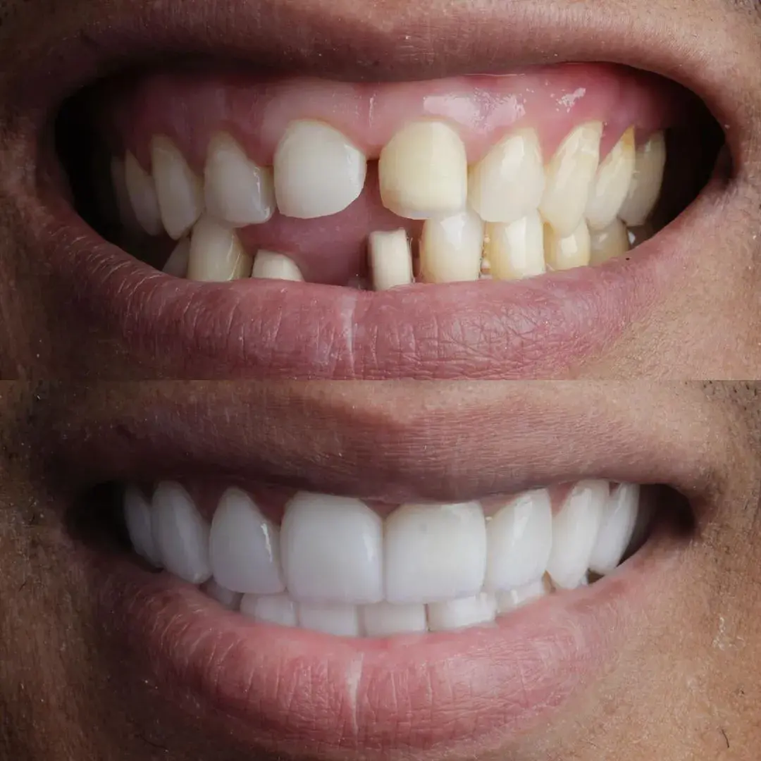 Renew your smile in just a few days! With over 15 years of experience, we offer a complete Smile Design service with porcelain veneers for international patients.#emaxveneers #cali #dentalesthetics