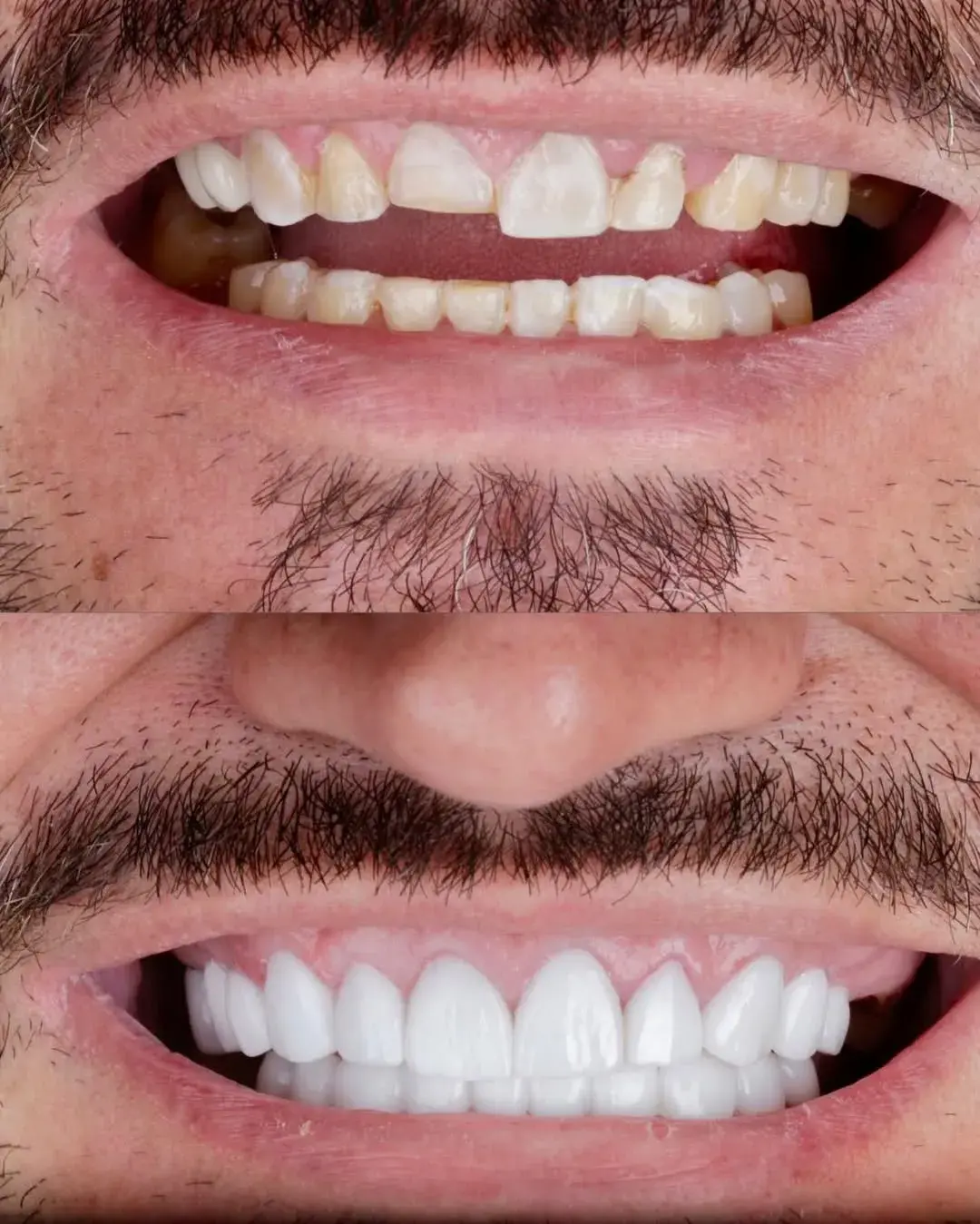 Tratamientos de excelente calidad, pacientes felices , #emaxveneers